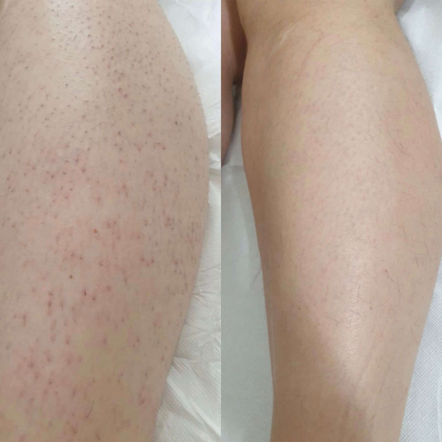 Estetica Blery - Epilazione Laser - Case Study #1