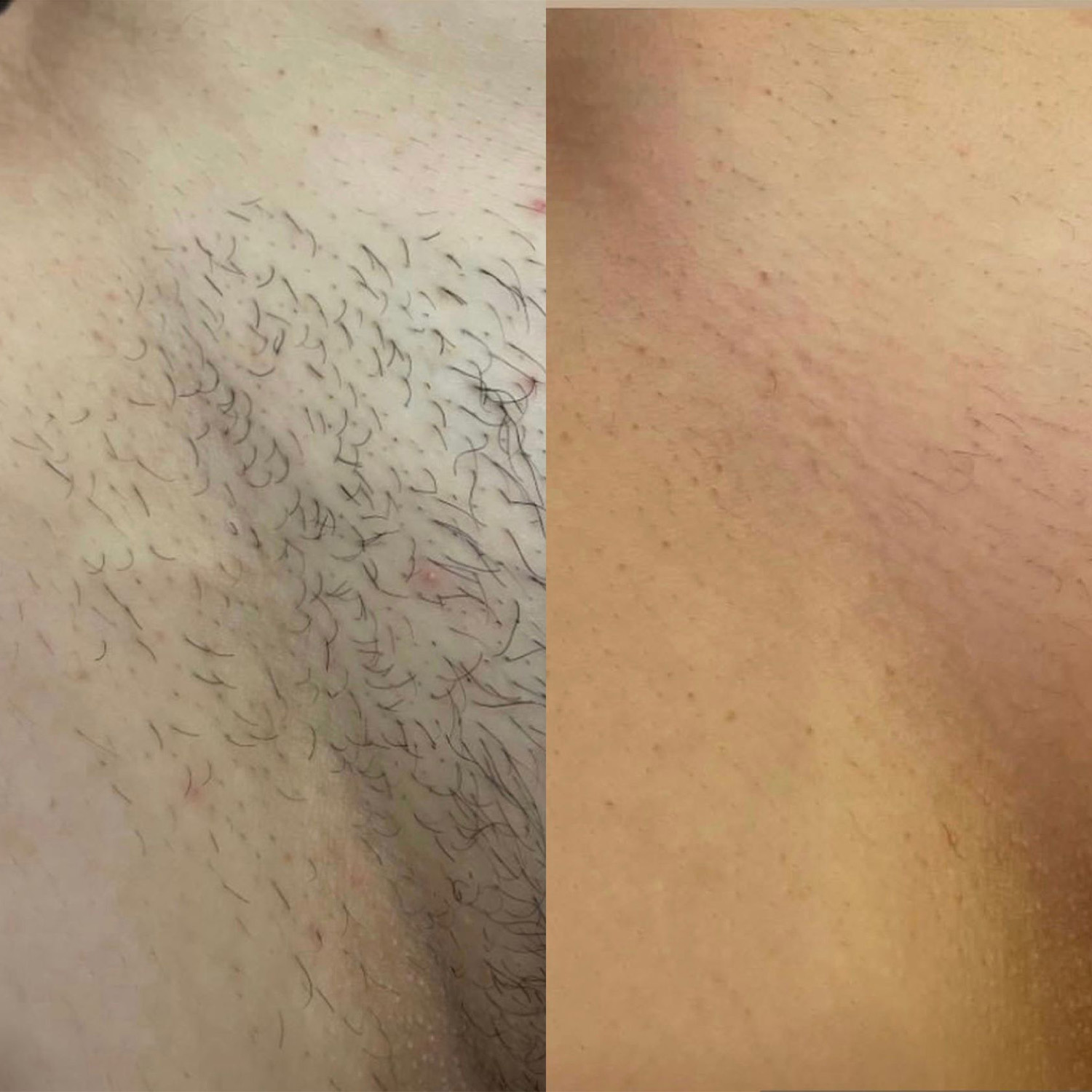 Estetica Blery - Epilazione Laser - Case Study #2