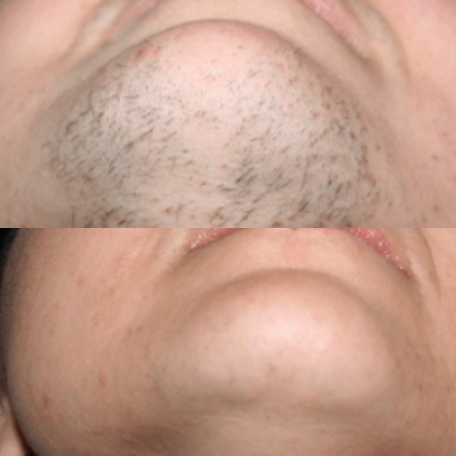 Estetica Blery - Epilazione-Laser - Case Study #3